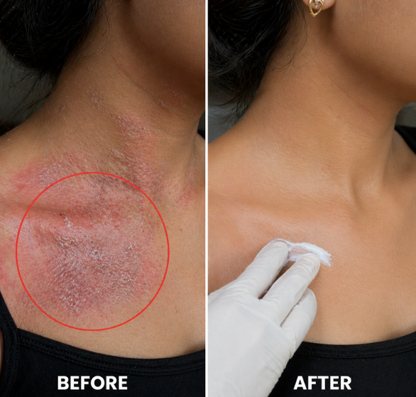 Psoriasis